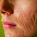 acne scar treatment
