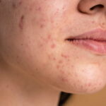 acne scar removal