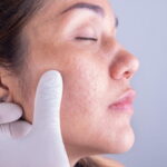 acne scar treatment