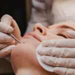 woman undergoing blackhead removal treatment