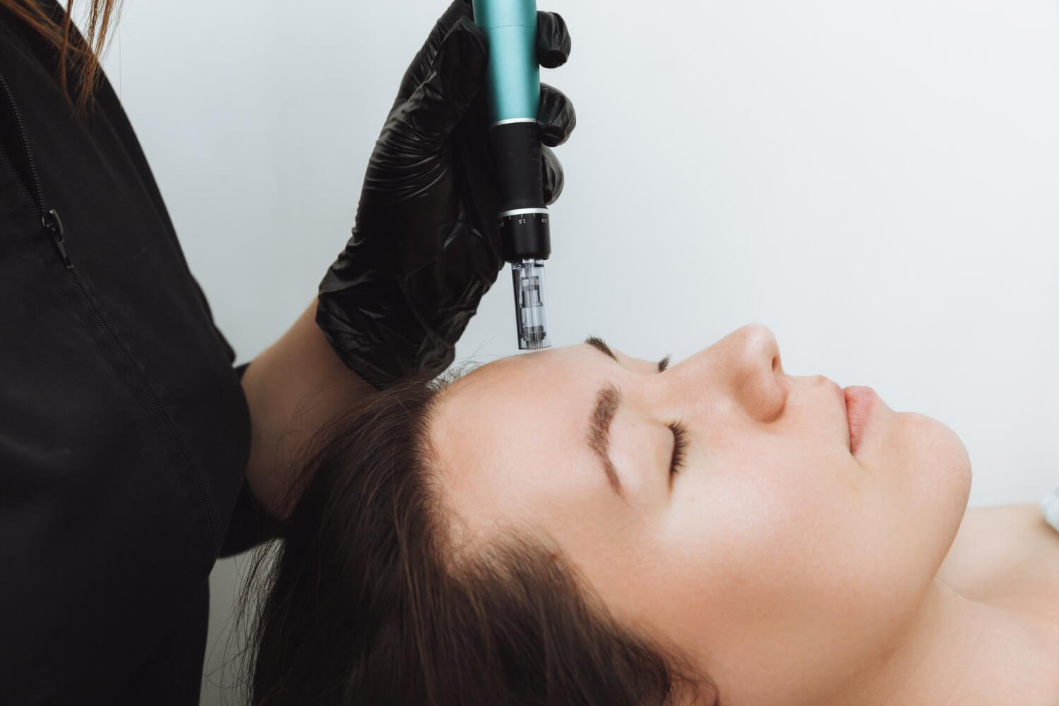 What Is Microneedling and Why It Benefits the Skin