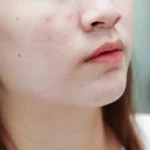 acne scar treatment