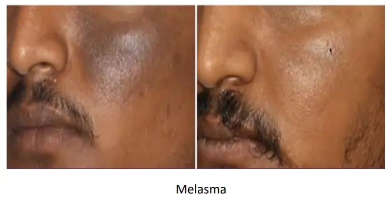 melasma