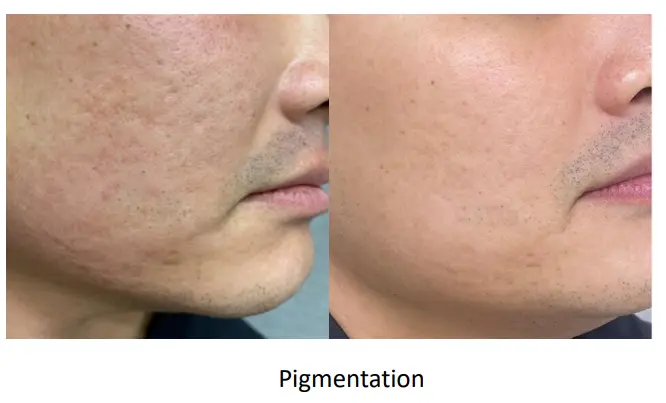 pigmentation
