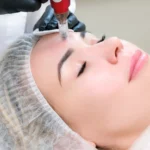 microneedling