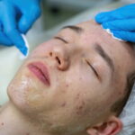 patient going through acne scar treatment