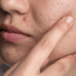 face with pimples