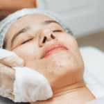 woman getting acne scar treatment