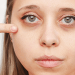 woman with dark eye circles