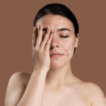 woman with hand on her face with acne scar