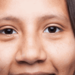 before and after of eye bags removal