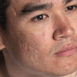 man before acne scar treatment