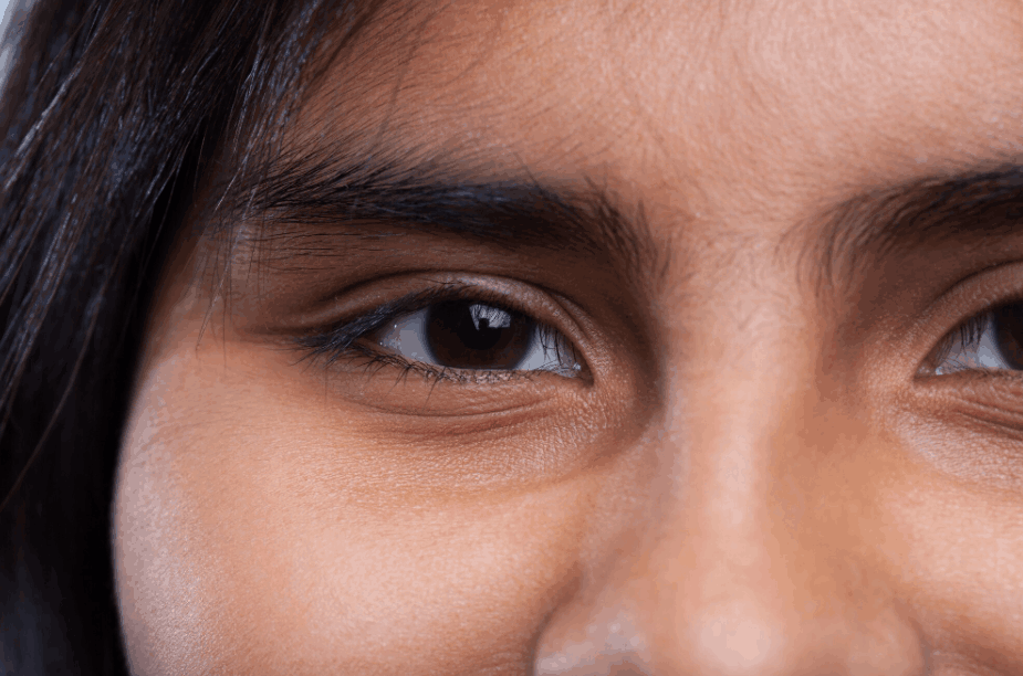 woman with dark eye circles