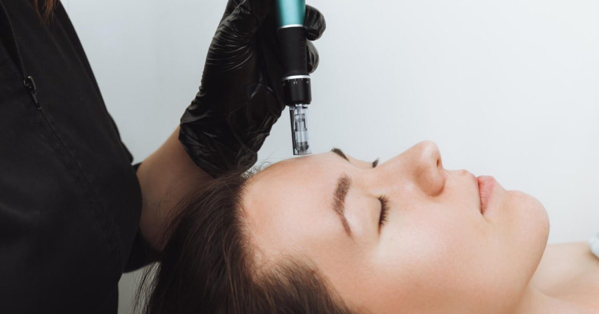 patient undergoing microneedling procedure