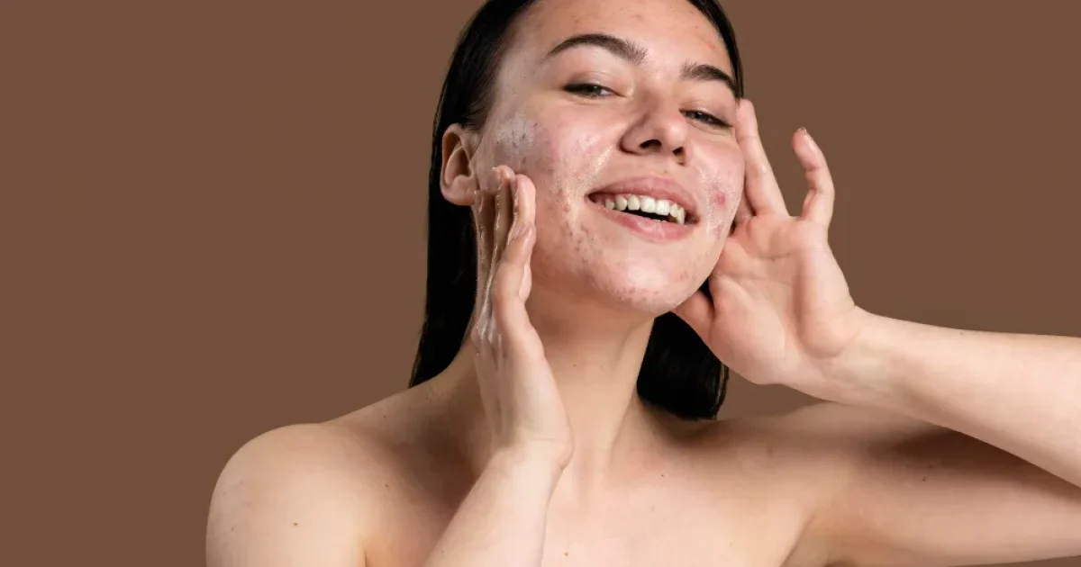 woman with acne on her face while smiling