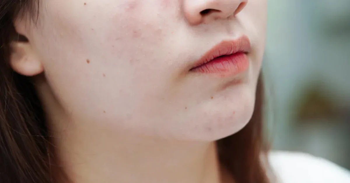 woman with acne on her face