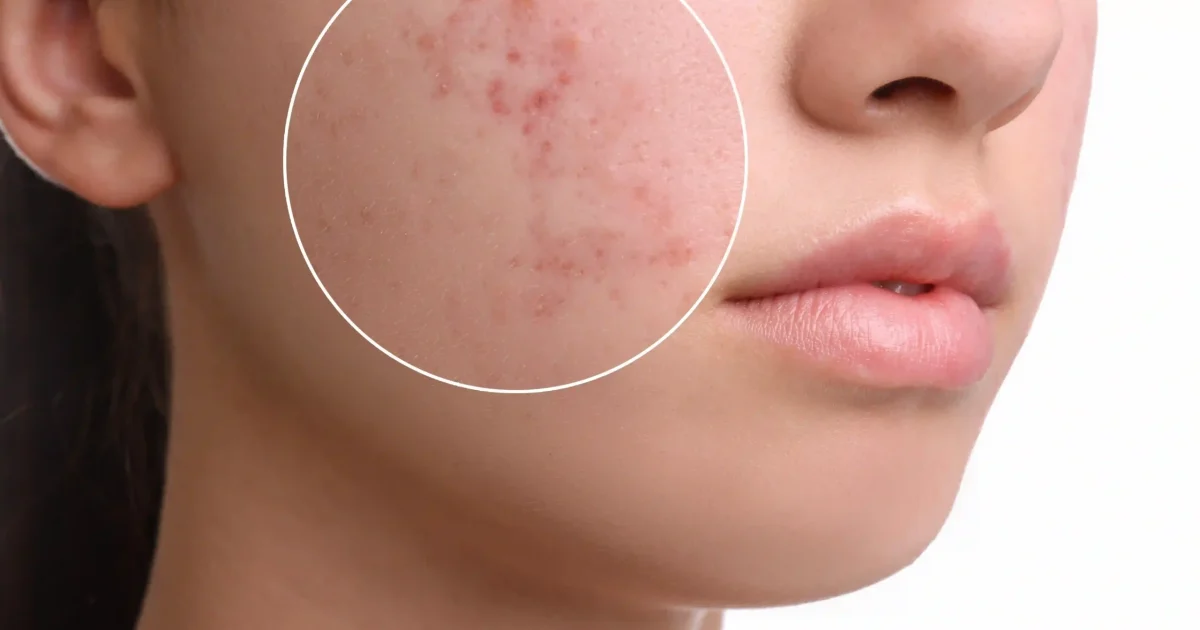 face with acne