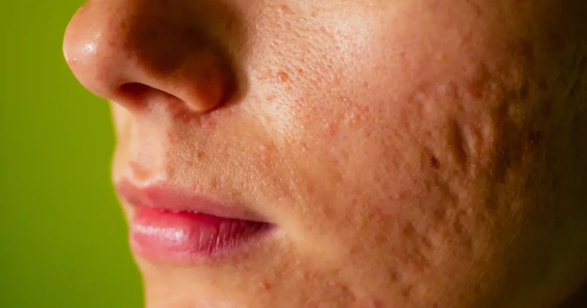 a face with acne scars