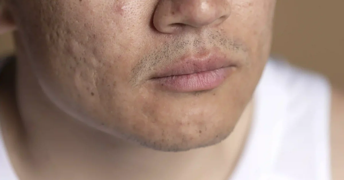 face with acne scars