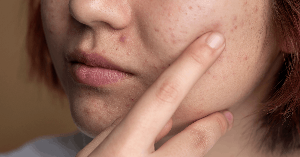 face with pimples