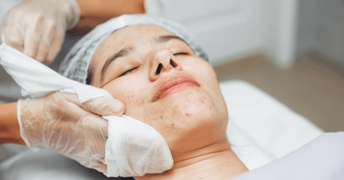 woman getting acne scar treatment