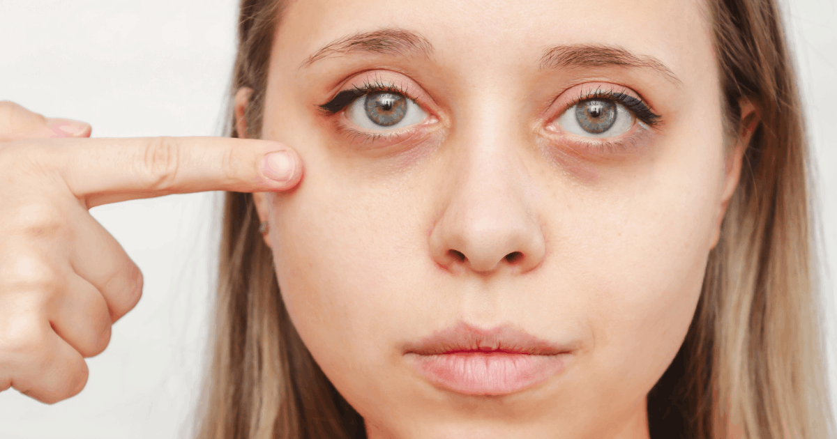woman with dark eye circles