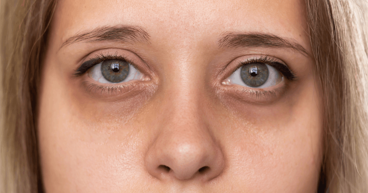 woman with dark eye circles