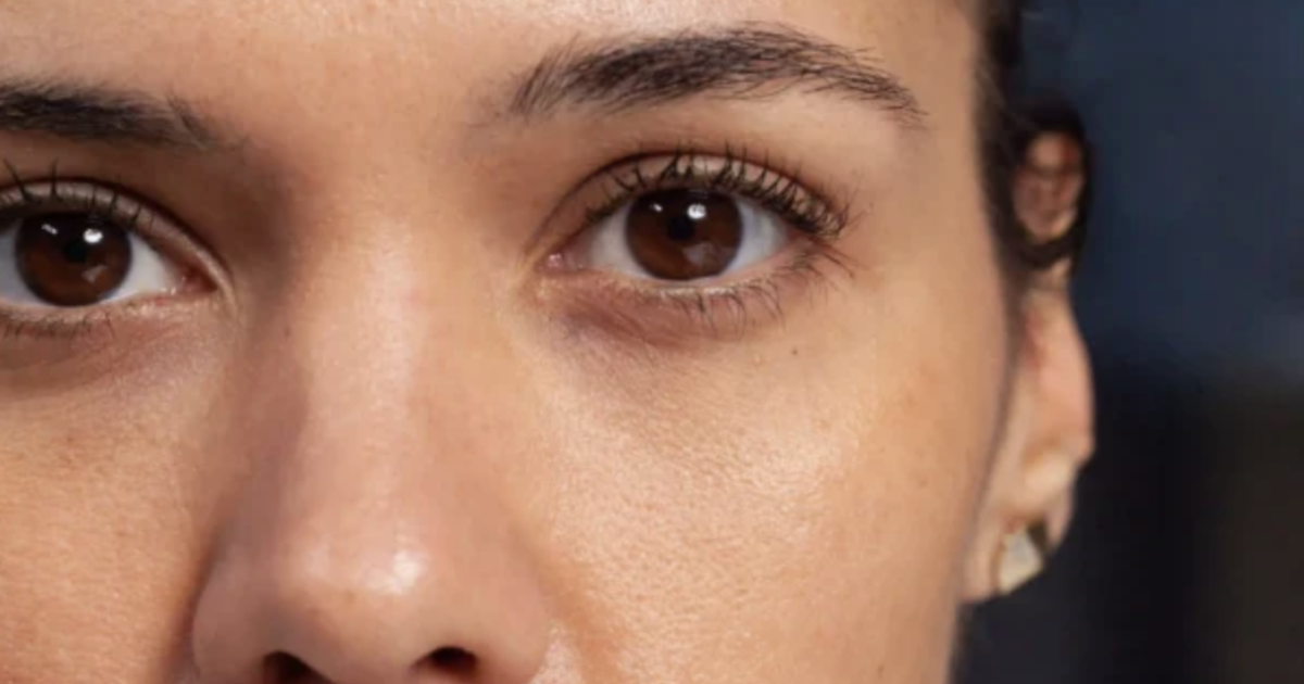 woman with dark eye circles
