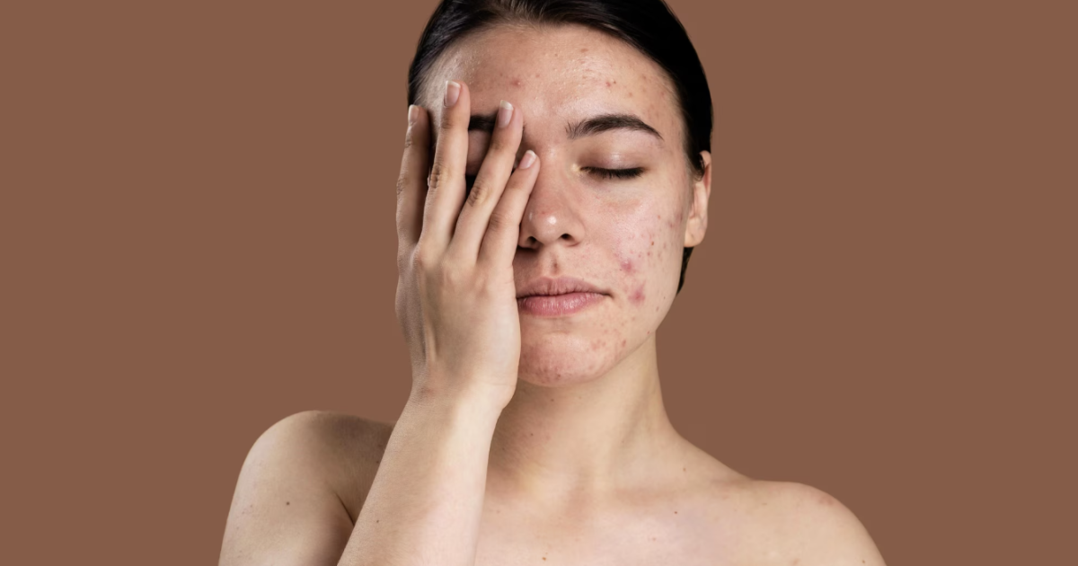 woman with hand on her face with acne scar