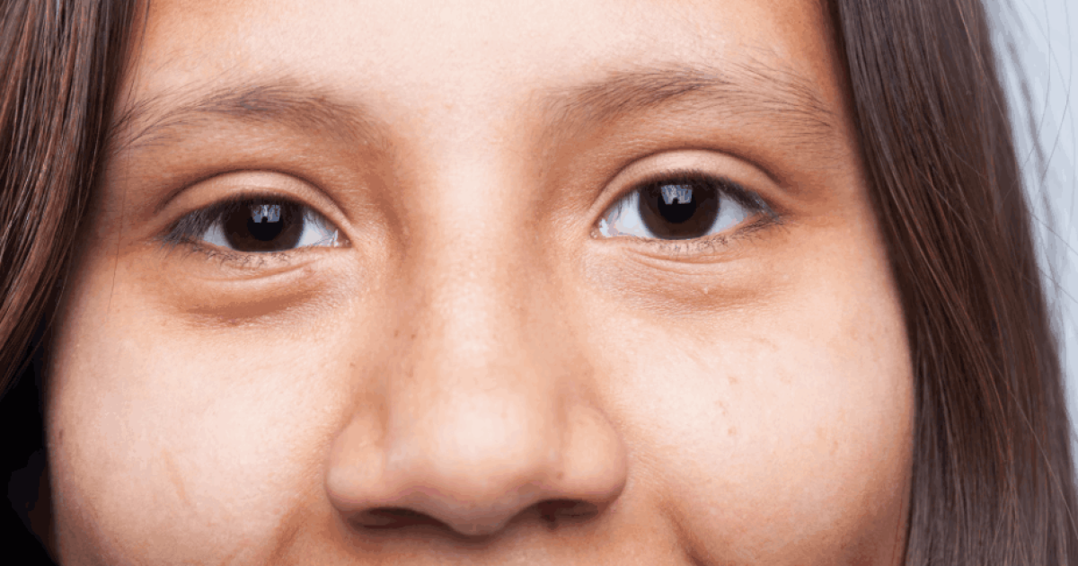 before and after of eye bags removal