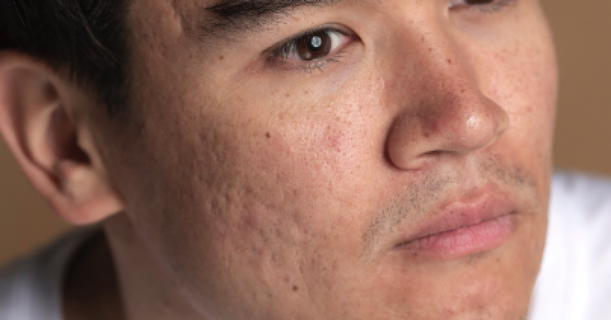 man before acne scar treatment
