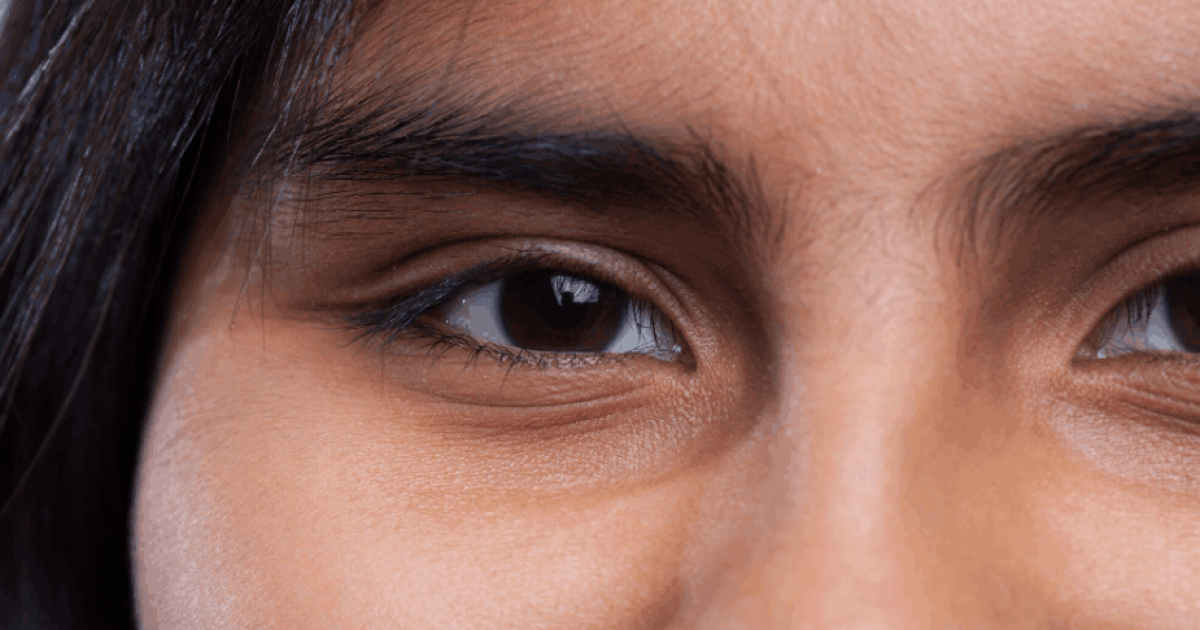 woman with dark eye circles