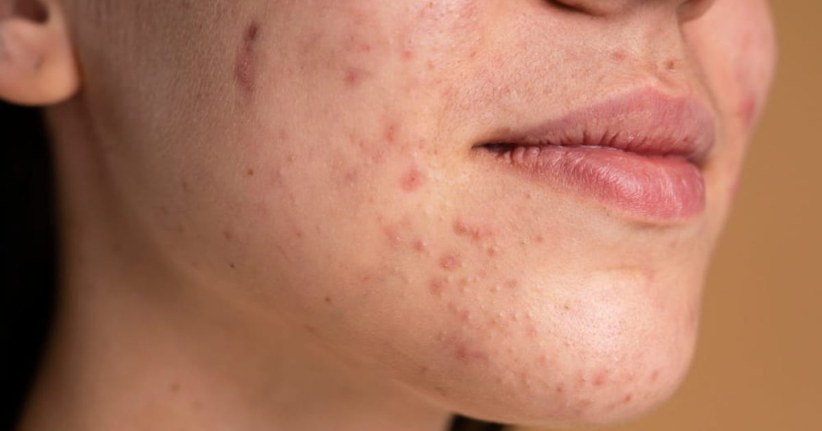 womna with acne scar