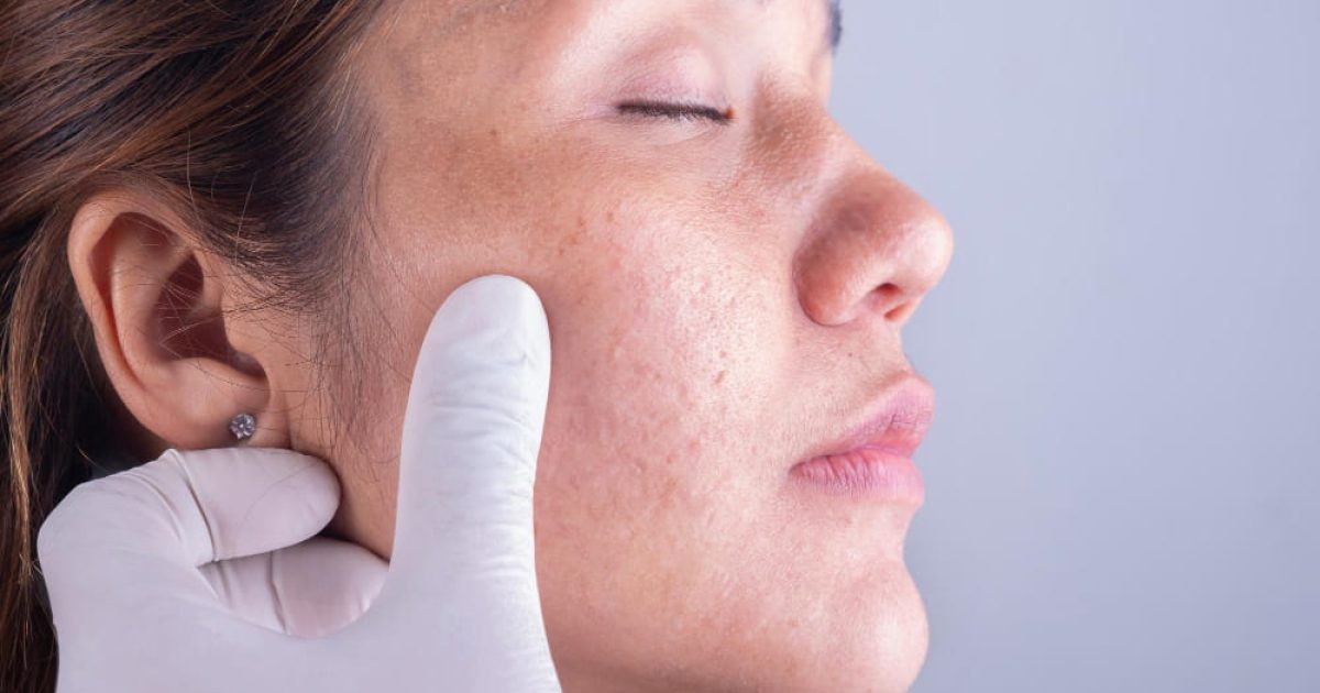 woman with acne scars and a hand on her face
