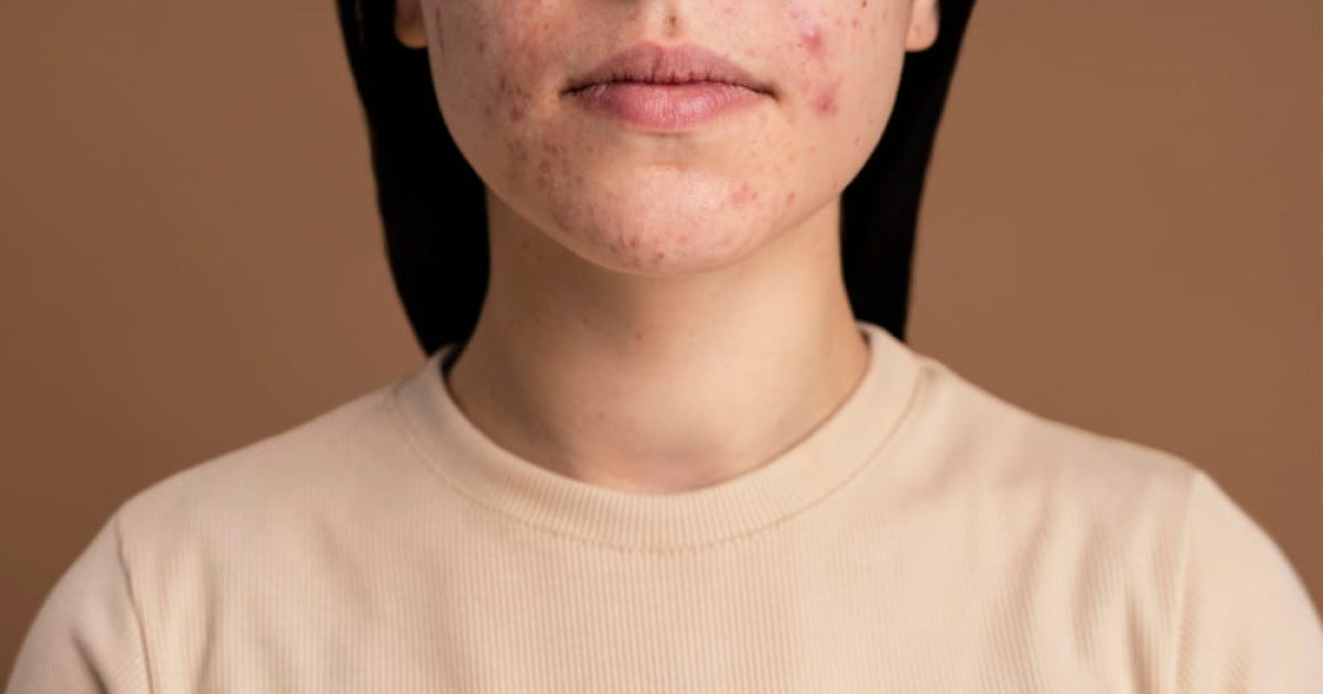 woman with acne scars