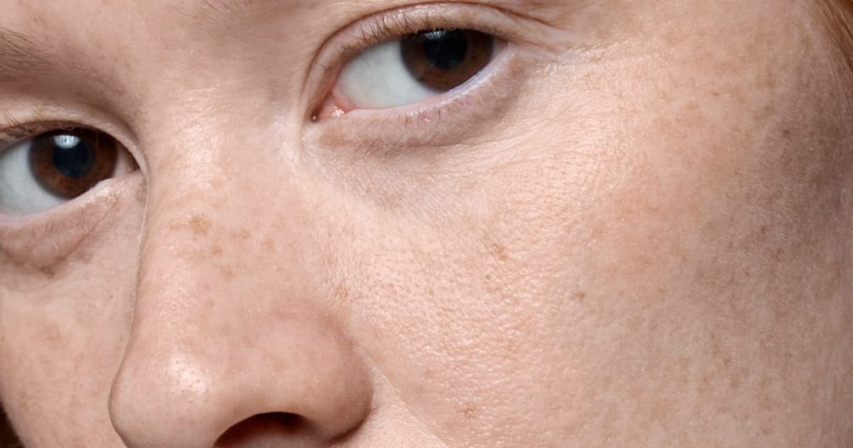 woman with dark eye circles