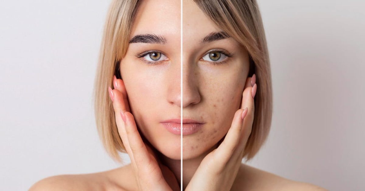 woman with and without dark spots or pigmentation