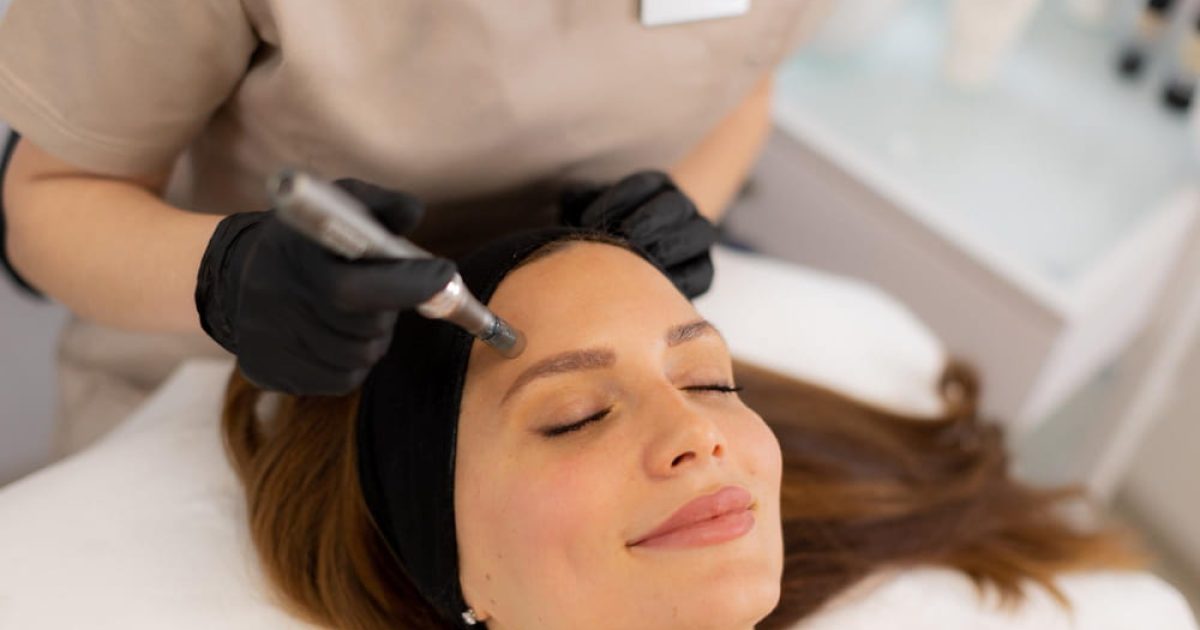 microneedling