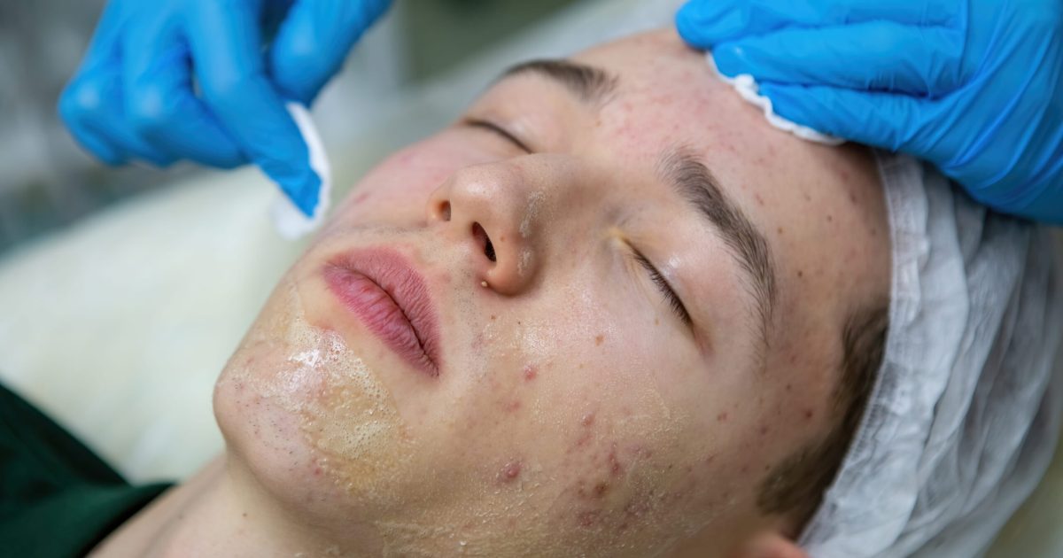 patient going through acne scar treatment