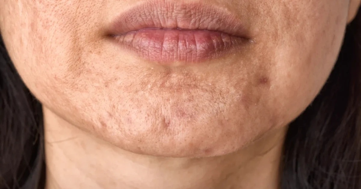 image of a face with acne scars