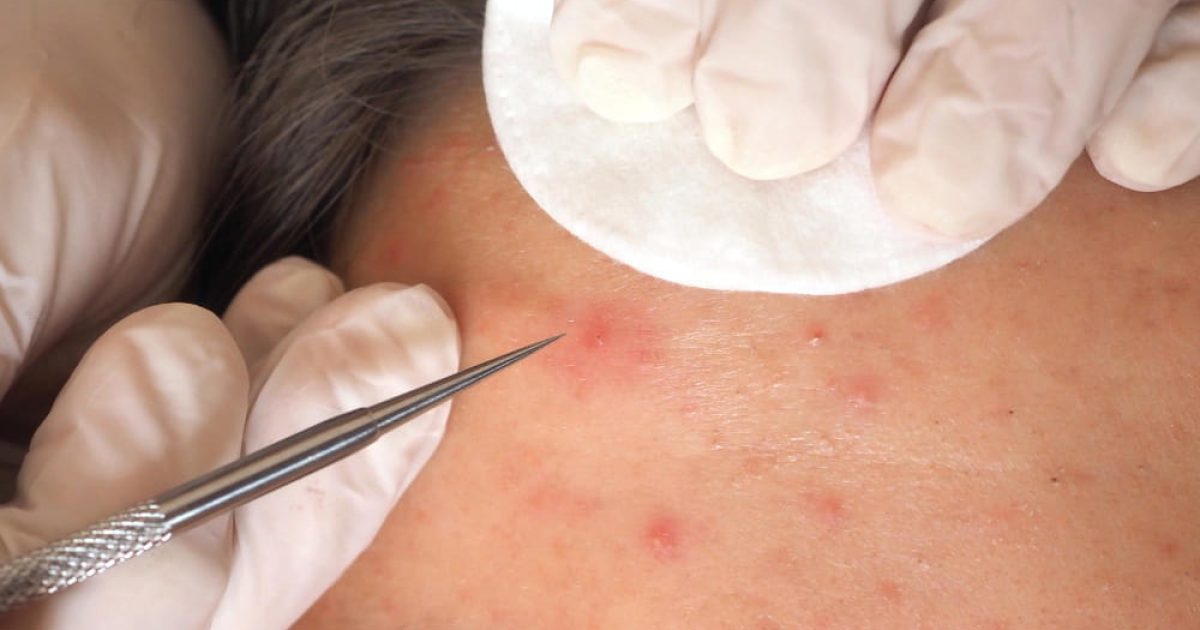 skin with acne, and a hand using a needle to poke it